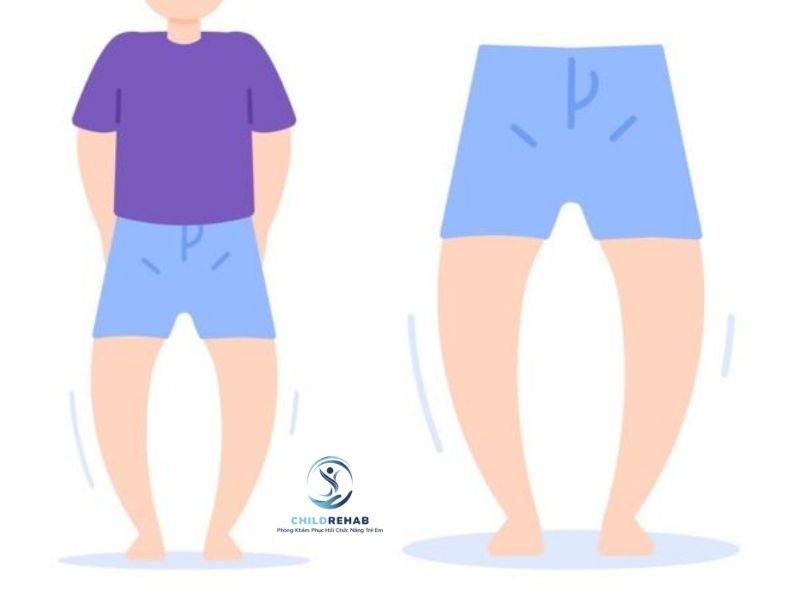 Chân Chữ O Ở Trẻ 6 Tuổi Có Cần Đưa Đi Đánh Giá Không? 2026 | ChildRehab