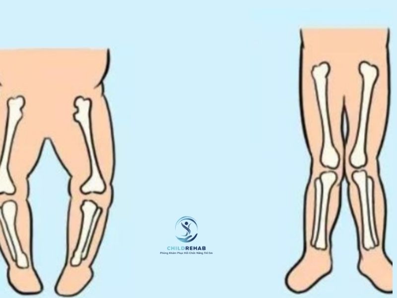 Chân Chữ O Ở Trẻ Có Liên Quan Đến Chân Chữ X Sau Này Không? 2026 | ChildRehab