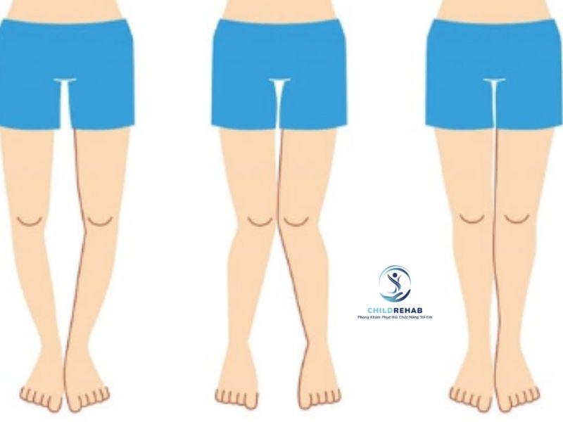 Phụ Huynh Nên Làm Gì Khi Nghi Ngờ Trẻ Bị Chân Chữ O? 2026 | ChildRehab
