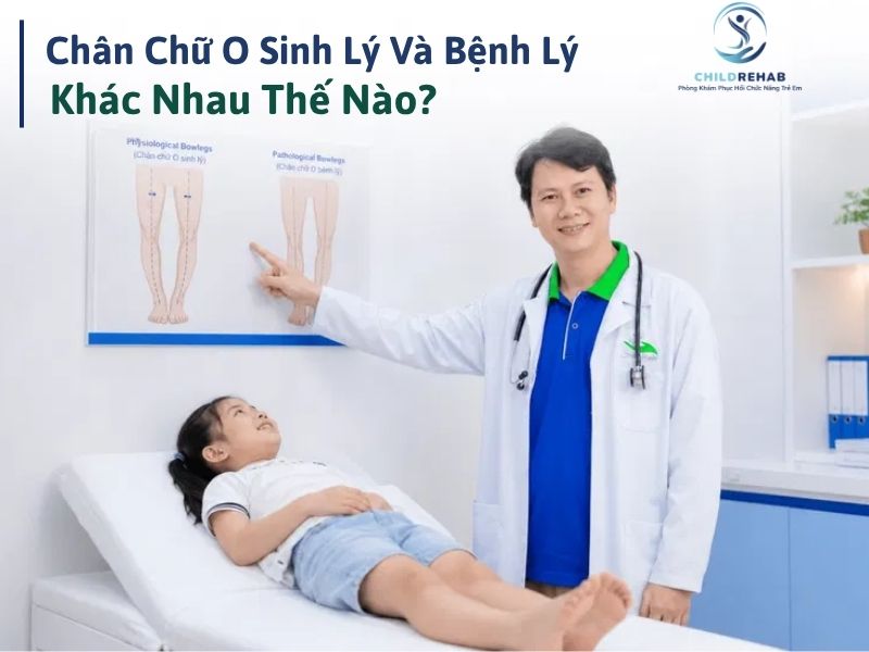 Chân Chữ O Sinh Lý Và Bệnh Lý Khác Nhau Thế Nào? 2026 | ChildRehab