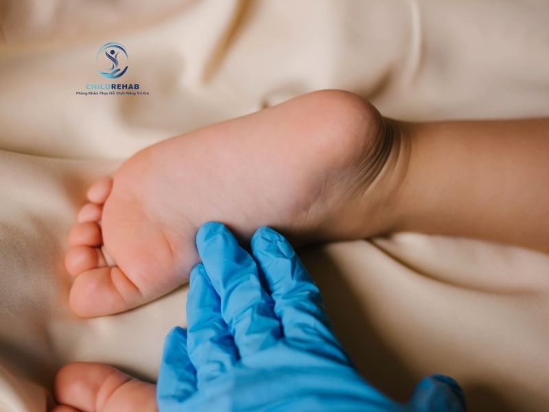 Bàn chân bẹt bẩm sinh là gì, có nguy hiểm không và khi nào cần can thiệp.