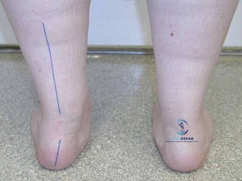 ban-chan-bet-co-lam-tre-bi-chan-chu-o-khong