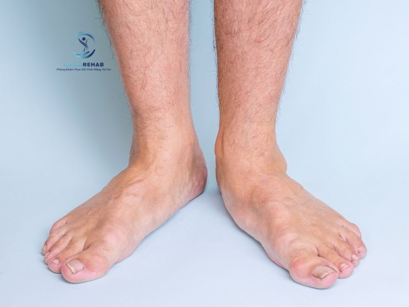 Bàn chân bẹt có liên quan gì đến chân chữ X ở trẻ.