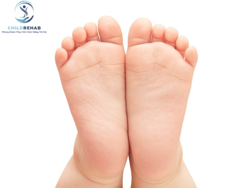 Bàn chân bẹt có liên quan gì đến lệch trục chi dưới ở trẻ?