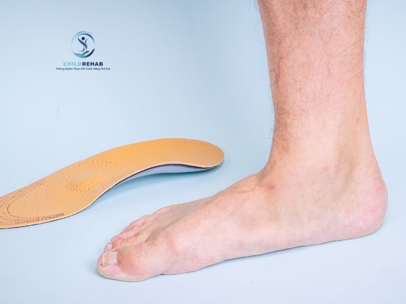 Tổng quan các hướng điều trị và hỗ trợ bàn chân bẹt ở trẻ hiện nay.