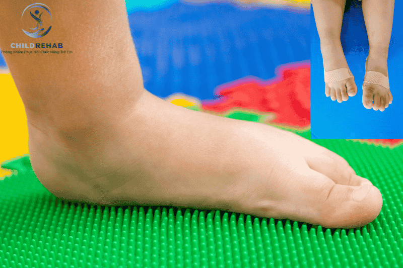 Bàn chân bẹt ở trẻ em có tự hết không? Khi nào cần vận động trị liệu can thiệp