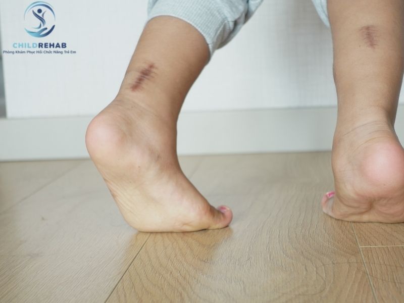 Phụ huynh có thể nhận biết trẻ đi nhón chân bất thường qua những dấu hiệu nào?