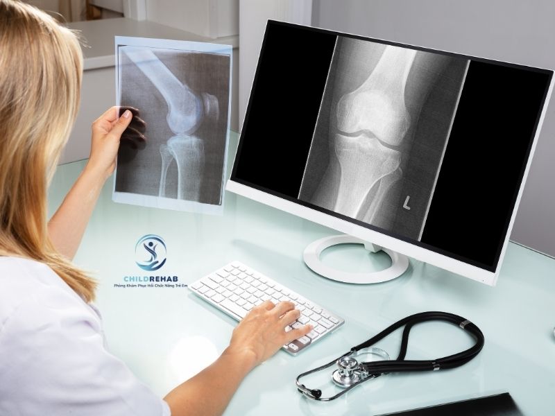 Vì sao phát hiện sớm và hỗ trợ sớm chân chữ X ở trẻ lại quan trọng.