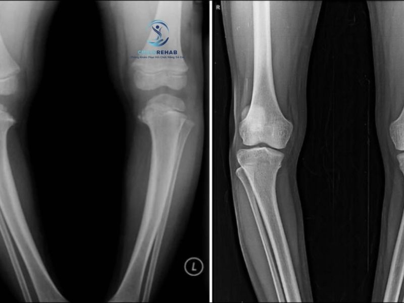 chan-chu-o-o-tre-co-can-chup-x-quang-khong