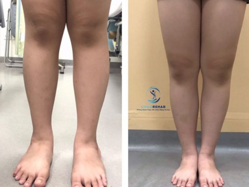 chan-chu-o-o-tre-co-lam-tre-di-cham-khong