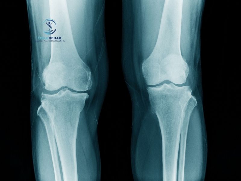 Không phải trường hợp nào chân chữ X ở trẻ cũng cần chụp X-quang.