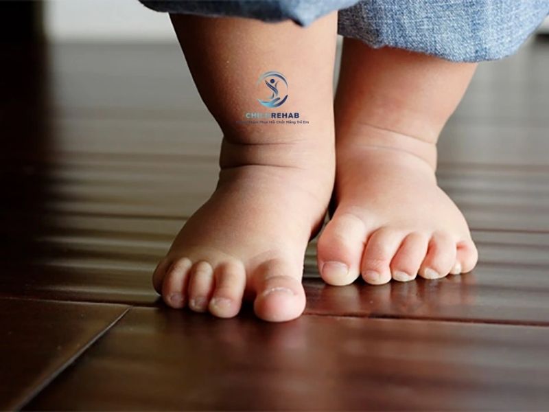 Tìm hiểu chân chữ X ở trẻ là gì.