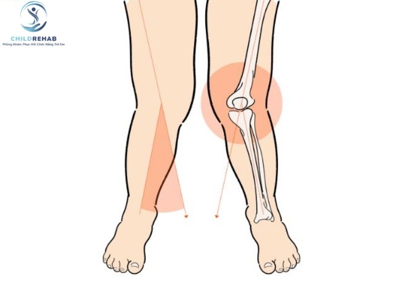 Tìm hiểu chân chữ X ở trẻ là gì.