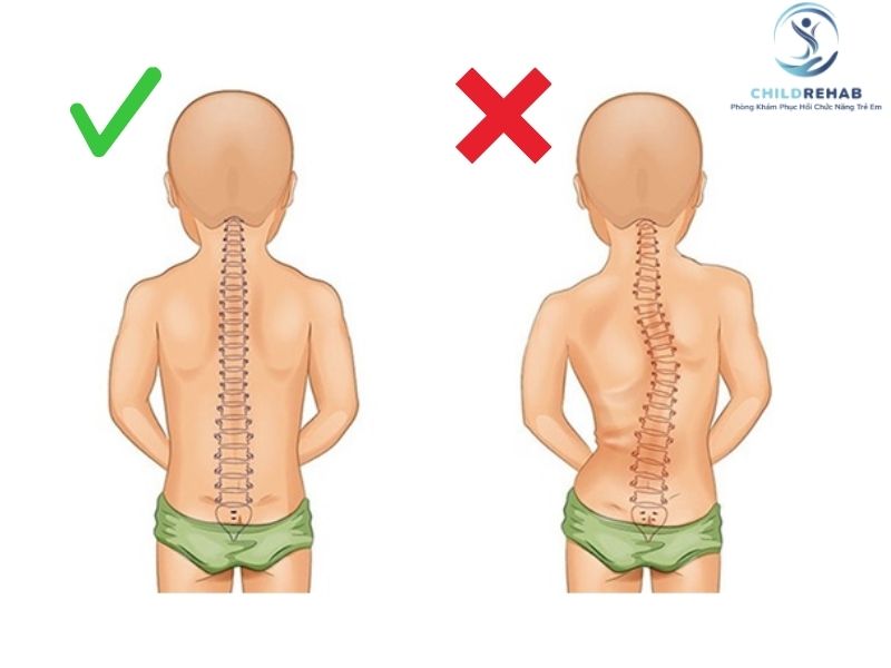 Tìm hiểu cong vẹo cột sống ở trẻ là gì, dấu hiệu nhận biết, nguyên nhân và khi nào cần đánh giá sớm cùng ChildRehab.