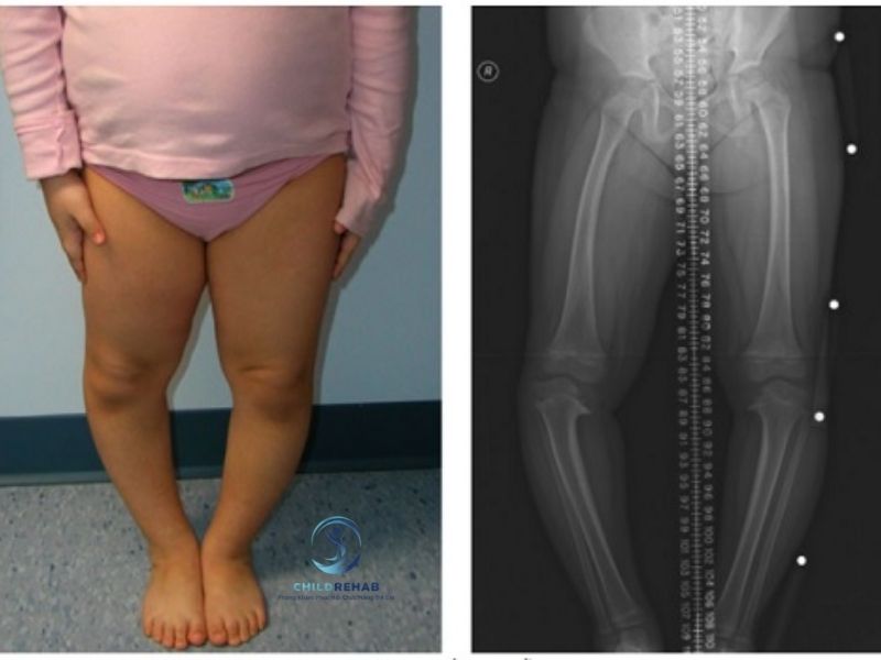 danh-gia-chan-chu-o-o-tre-gom-nhung-gi