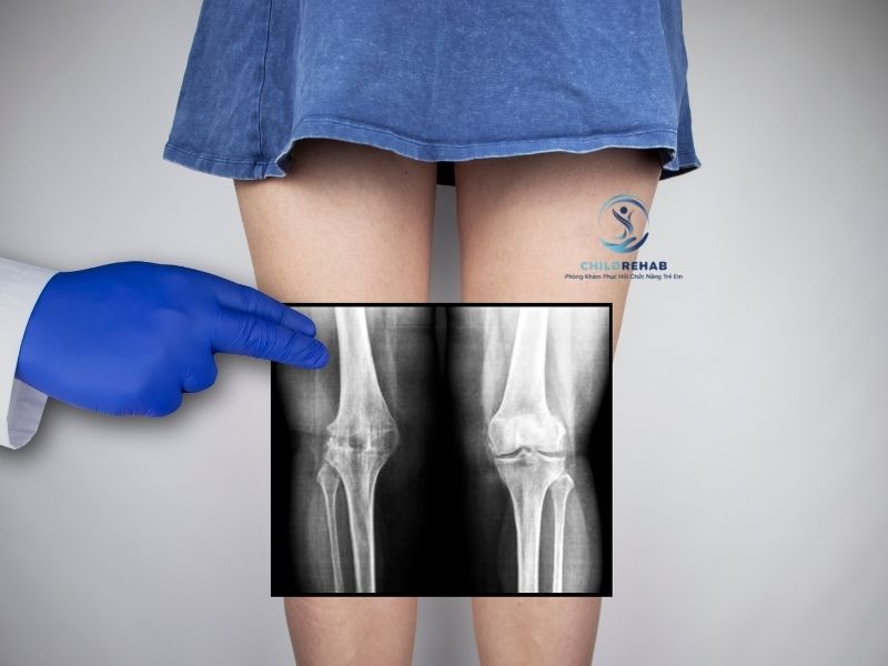 Tìm hiểu các hướng hỗ trợ và điều trị chân chữ X ở trẻ tùy theo độ tuổi, mức độ và nguyên nhân liên quan.