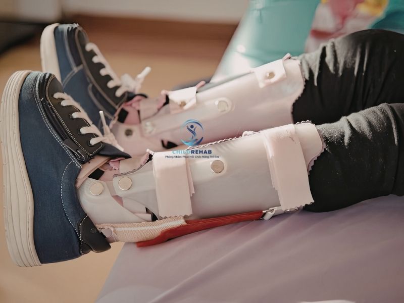 Giày chỉnh hình có phải giải pháp cho trẻ bị chân chữ X không.