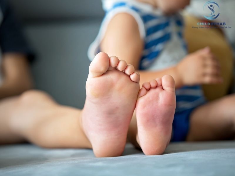 Chân trẻ nhìn không đều có thể liên quan đến lệch trục chi dưới