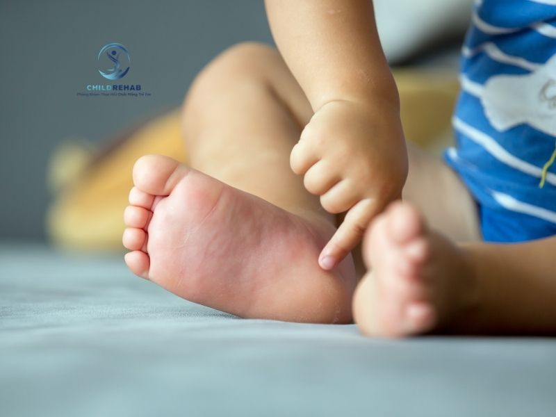 Cách phân biệt bàn chân bẹt sinh lý và bệnh lý để cha mẹ không chủ quan.