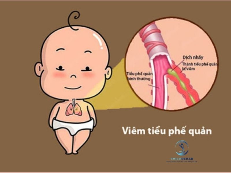 phuc-hoi-ho-hap-viem-tieu-phe-quan