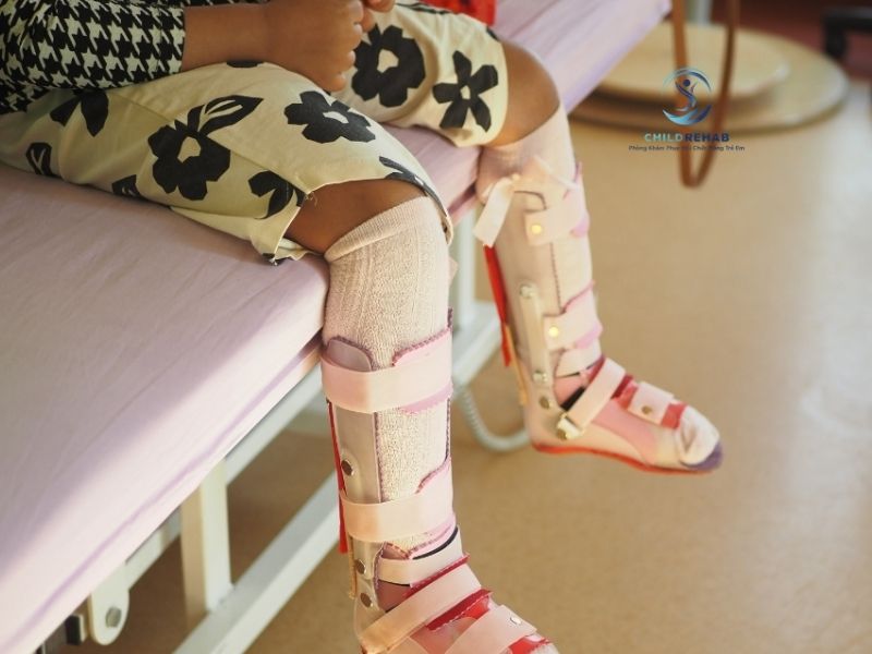 Nẹp chỉnh hình có phù hợp cho mọi trẻ bị chân chữ X hay không.