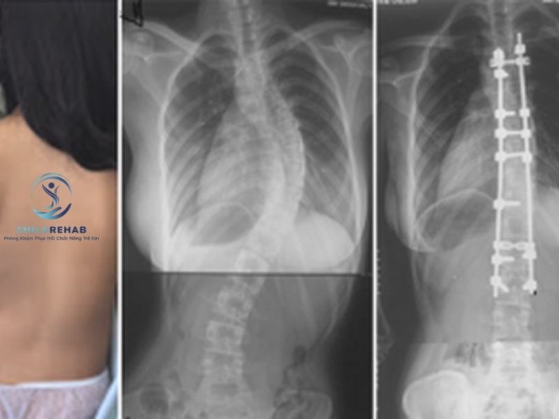 Không phải trường hợp nào trẻ bị cong vẹo cột sống cũng cần chụp X-quang. 