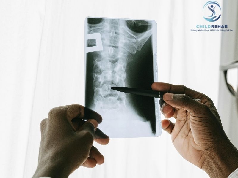 Không phải trường hợp nào trẻ bị sai tư thế cũng cần chụp X-quang.