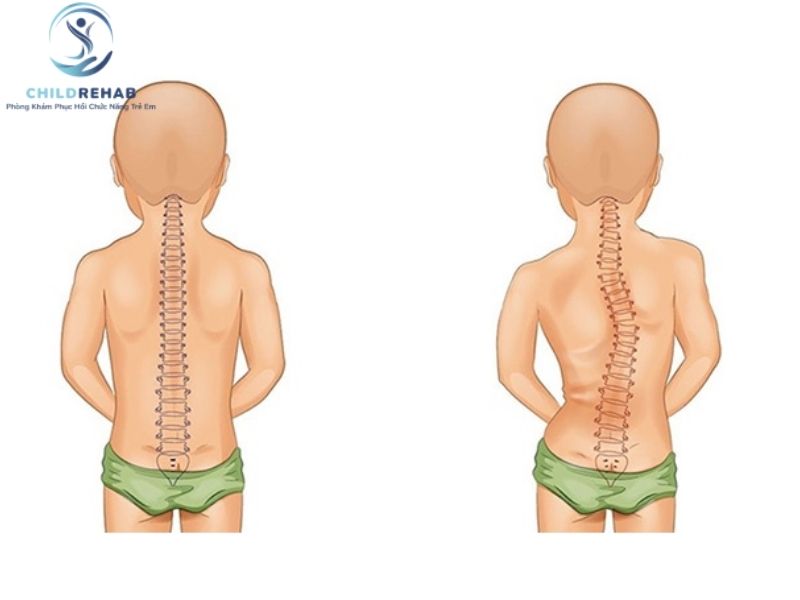 Trẻ đứng lệch vai có thể liên quan đến sai tư thế hoặc mất cân đối thân mình.