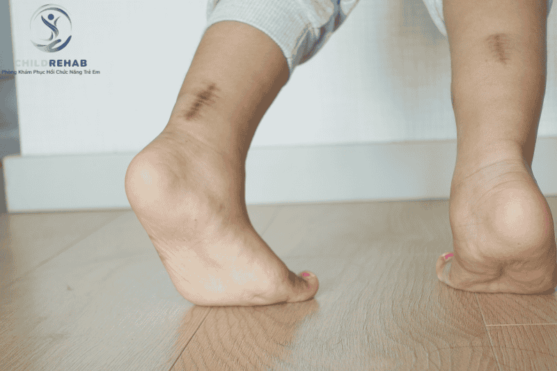 Trẻ hay kiễng chân khi đi có thể liên quan đến rối loạn vận động cần can thiệp
