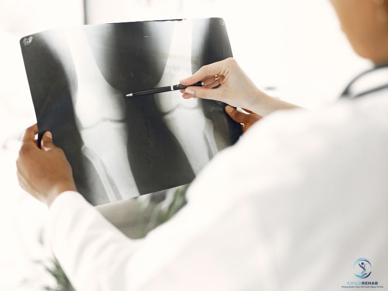  Không phải trường hợp nào trẻ lệch trục chân cũng cần chụp X-quang. 