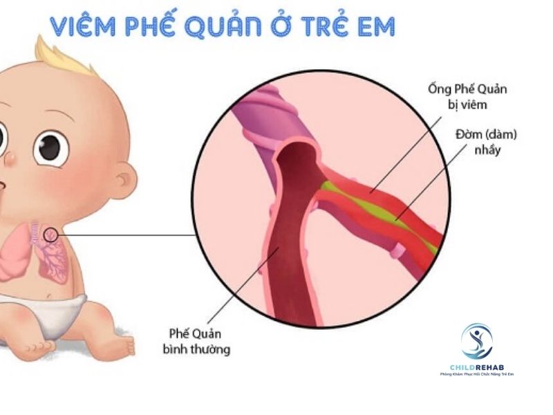 tre-viem-phe-quan-lap-lai