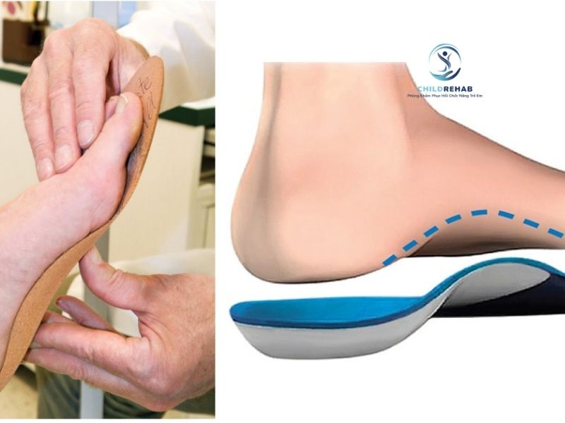 Vật lý trị liệu có thể giúp cải thiện chức năng và dáng đi ở trẻ bị bàn chân bẹt.