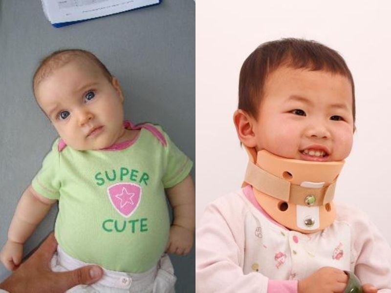 Phân biệt vẹo cổ cơ năng và vẹo cổ cấu trúc để lựa chọn hướng can thiệp phù hợp.