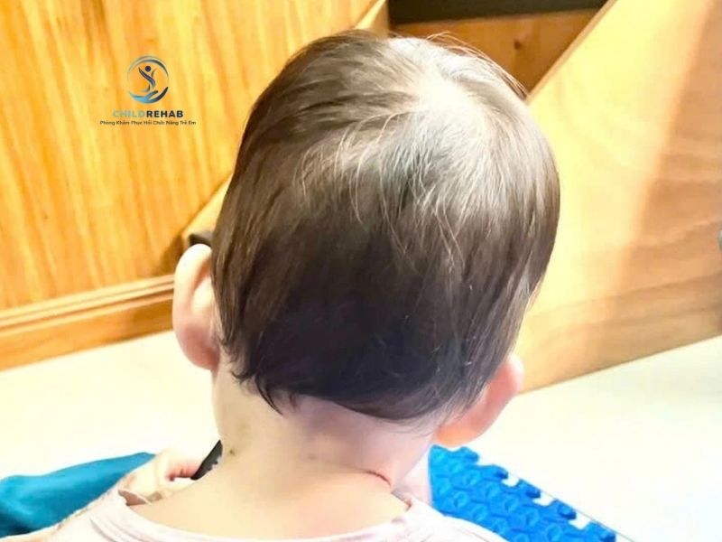 Các hướng điều trị vẹo cổ ở trẻ hiện nay và khi nào nên can thiệp sớm.